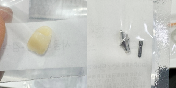 Pre-fabrication of implant abutment and prosthesis