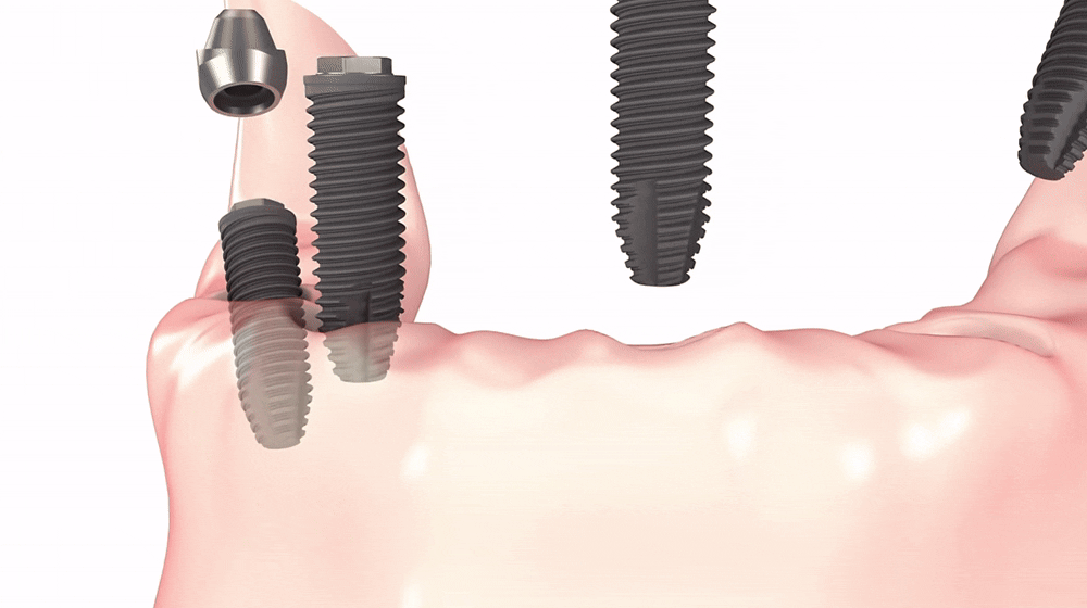 Full-Mouth Implant