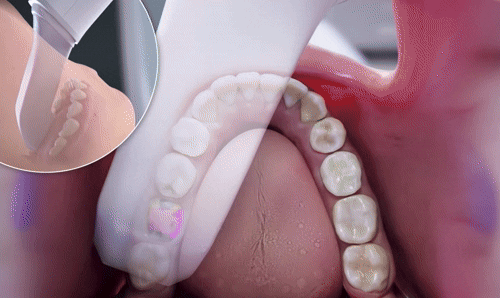 Digital 3D Intraoral Scan